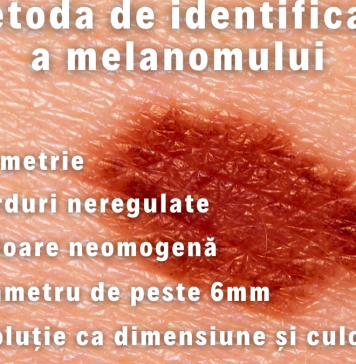 Sectorul 6: Campanie de informare privind regula ABCDE de control al alunițelor de pe piele