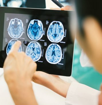 3 semne care te ajută să recunoști un accident vascular cerebral