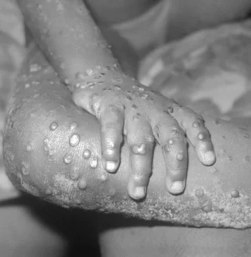 Variola maimuţei: Ce este boala, cum se răspândeşte și care sunt simptomele