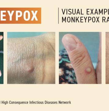 Un nou caz nou de variola maimuței depistat în Capitală