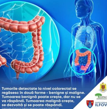 Ilfov: Continuă programul de prevenţie, depistare precoce, diagnostic şi tratament precoce al leziunilor precanceroase colorectale