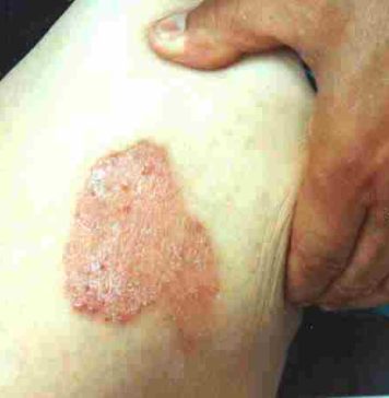 Semnal de alarmă: Peste 50% dintre cazurile de psoriazis din România – nediagnosticate si netratate