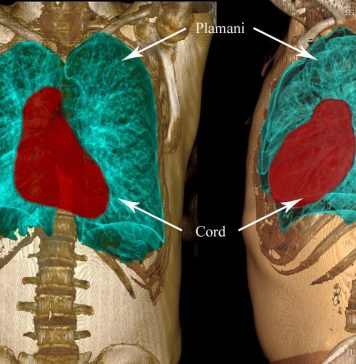 Pacient cu o tumoră pleurală fibroasă solitară gigant, operat cu succes la Spitalul Universitar de Urgenţă Bucureşti