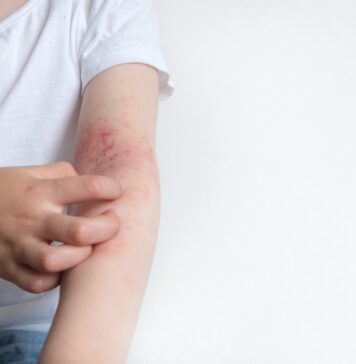 Campanie senzorială pentru conștientizarea dermatitei atopice, afecţiunea de care suferă aproximativ 10% din români