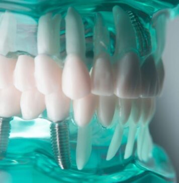 Care este diferența între un implant dentar ieftin și unul premium