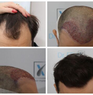 Implant de păr la clinică – pasul spre un nou început. Pentru detalii, vezi pe drfelixhairimplant.ro